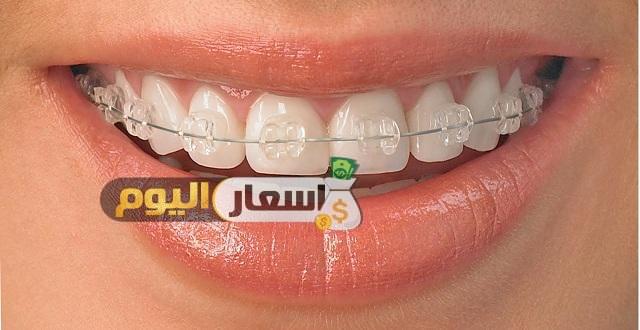 Photo of أسعار و تكلفة تركيب تقويم الأسنان 2022