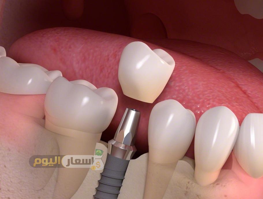 تكلفة زراعة الأسنان فى مصر 2019