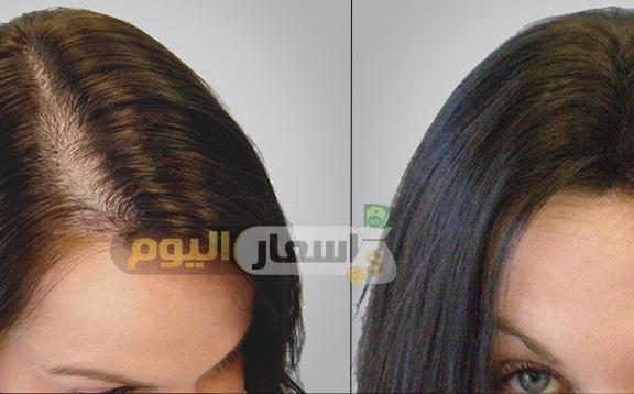 Photo of تكلفة زراعة الشعر في مصر 2023