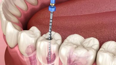 Photo of أسعار حشو الأسنان 2025